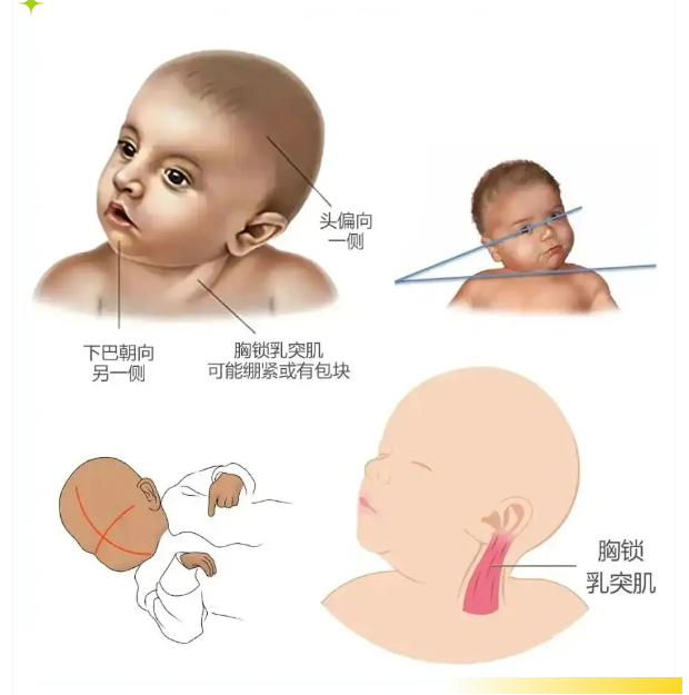儿童斜颈的治疗的