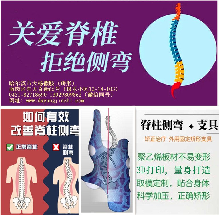 关注青少年脊柱侧弯