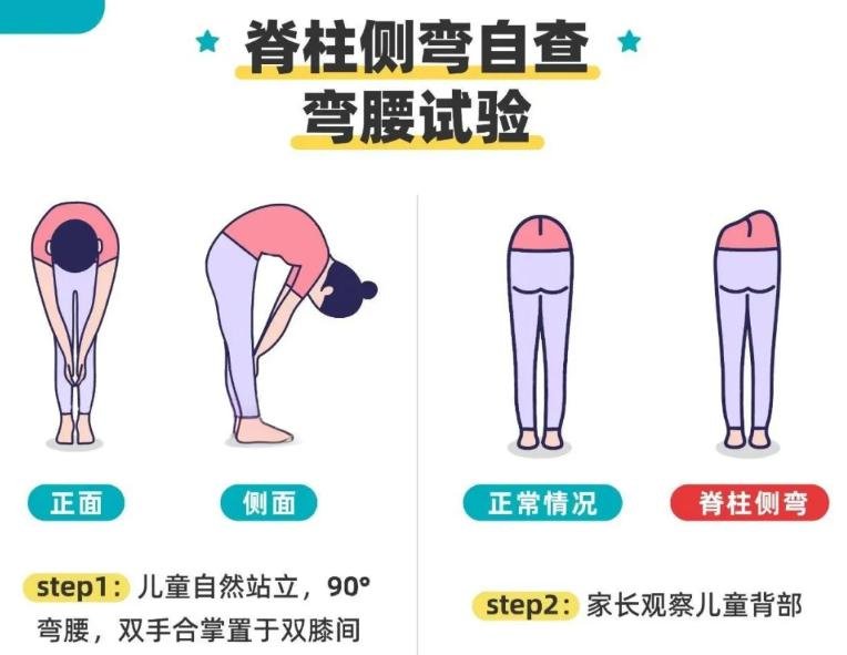 脊柱侧弯与自查