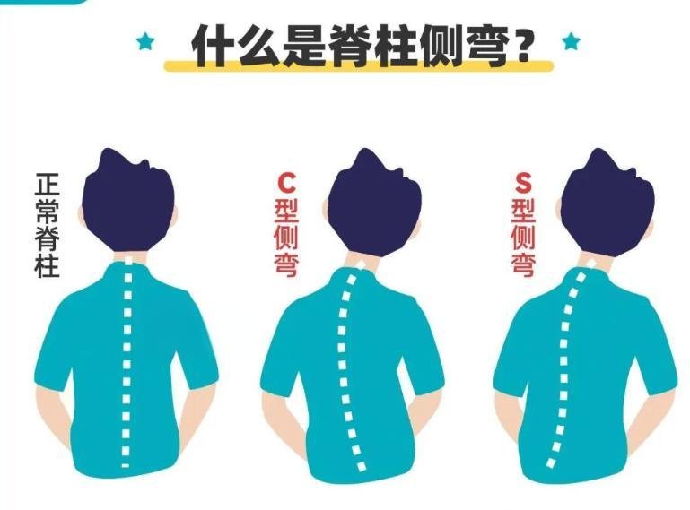 脊柱侧弯与自查