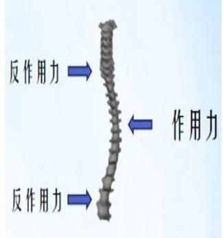 脊柱矫形器的治疗原理