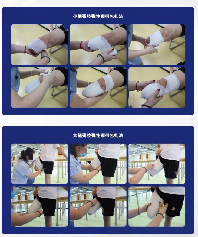 截肢术后的残肢塑型