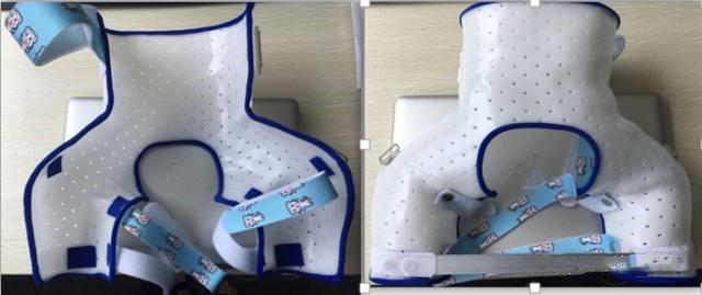 低温板材在下肢骨折上的应用