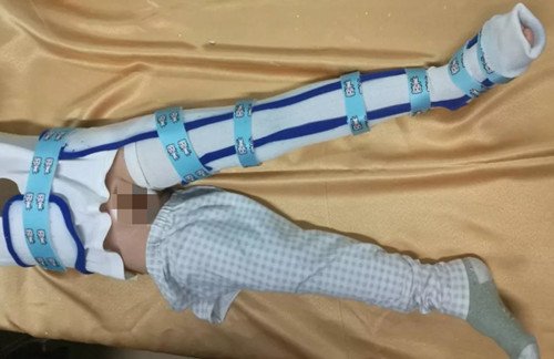 低温板材在下肢骨折上的应用