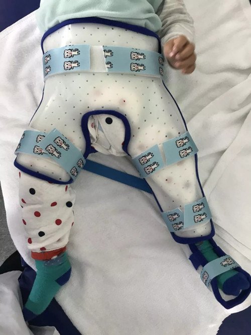 低温板材在下肢骨折上的应用