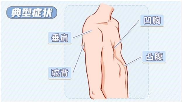 漏斗胸怎么矫正?