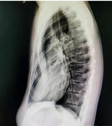 漏斗胸怎么矫正?