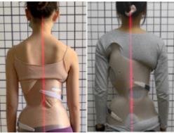 脊柱侧弯矫形器(支具)  