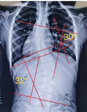 睡姿对脊柱侧弯患者的影响